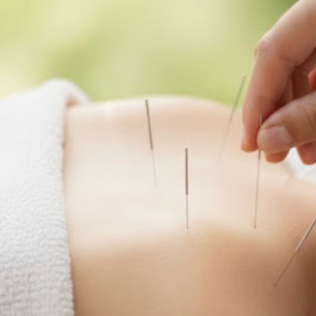 Acupuncture, ventouses et moxibustion — illustration 1