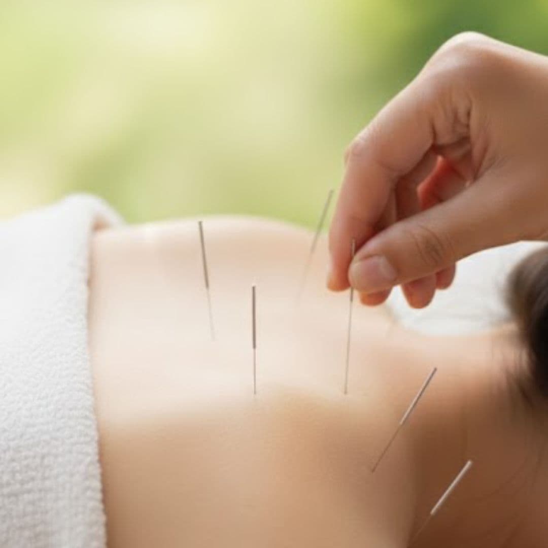 Acupuncture